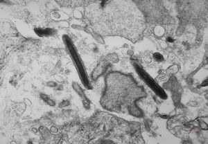 F,41y. | Whipple disease - duodenum